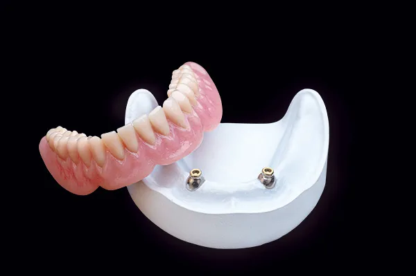 Two-implant removable overdenture with locator-style attachments