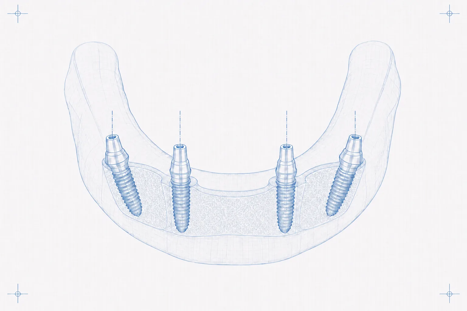 Four fixtures · two axial, two tilted posterior