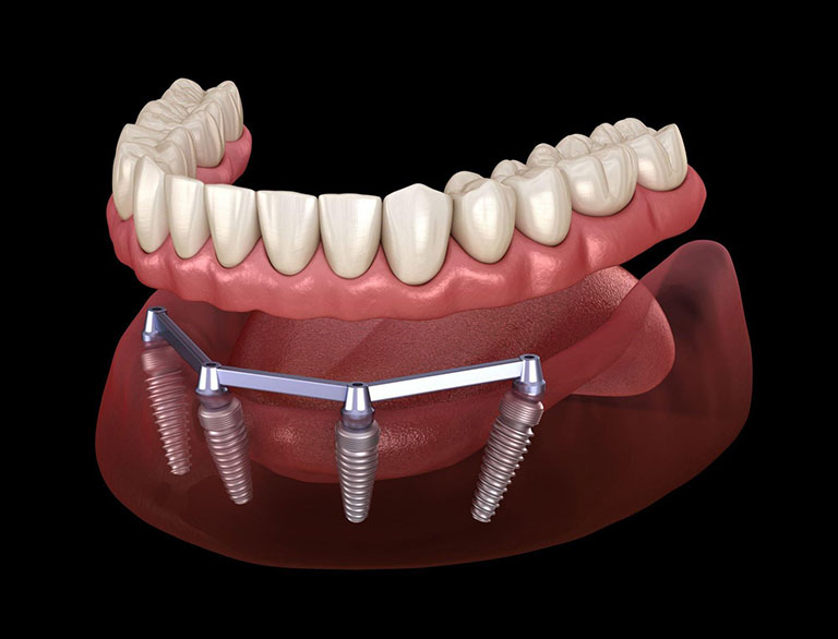 Benefits of All-On-4®